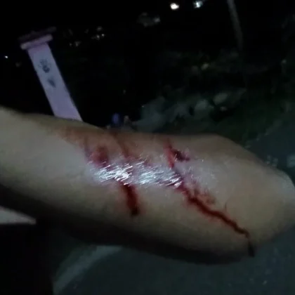 Luka bacok korban dalam kasus penganiayaan Luwu Utara setelah diserang dengan parang.